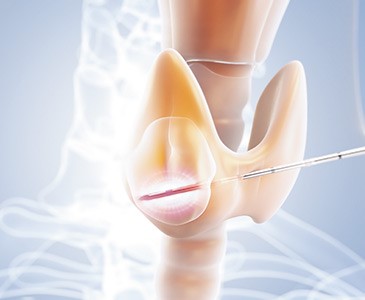 Bild einer Spezialsonde, die den Knoten in der Schilddr&uuml;se per Radiofrequenzablation erhitzt. 
&copy;Olympus Surgical Technologies Europe